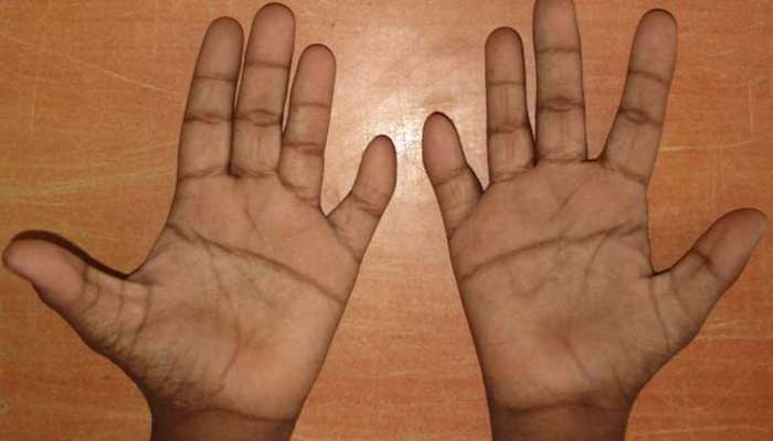 down-syndrome-pair-of-hands