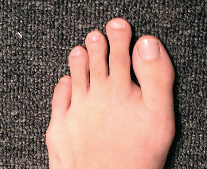Сонник большой палец. Длинные пальцы на ногп. Указательный палец на ноге. Корткикпальцы на ногах.