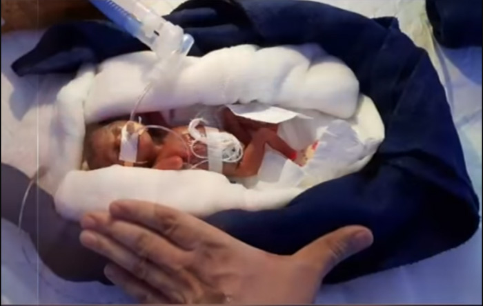 Baby Born Weighing Only 400 Grams Becomes Asia's Smallest ...